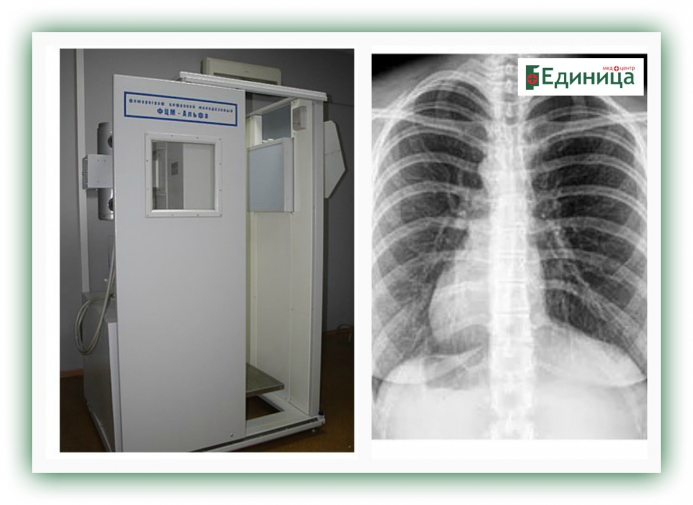 Фцм Альфа флюорограф. Флюорография ''l 175. Аппарат рентгеновский для флюорографии легких цифровой.