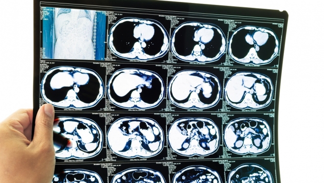 В районных больницах Марий Эл появятся новые томографы