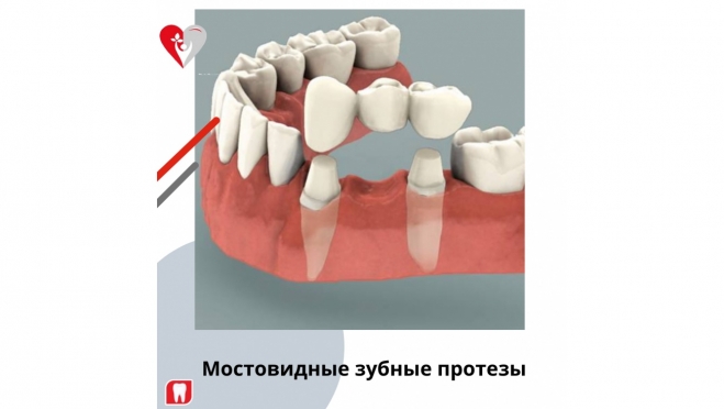 Мостовидные зубные протезы