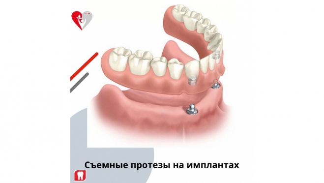 Съемные протезы на имплантах