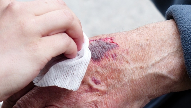 В Звениговском районе пожилая женщина получила серьёзные ожоги