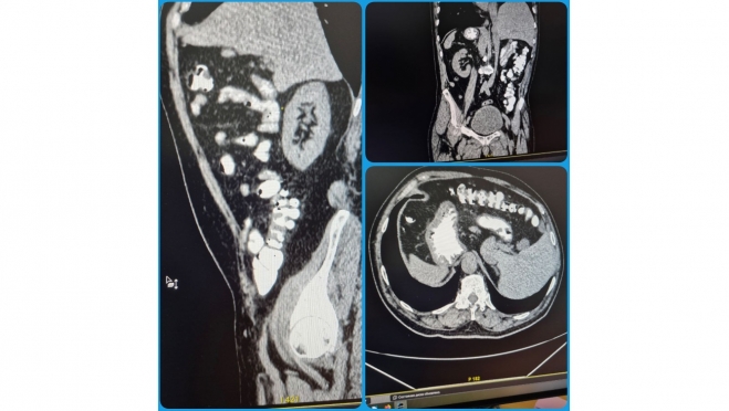 В Саратовской области медики столкнулись с редкой аномалией у пациента