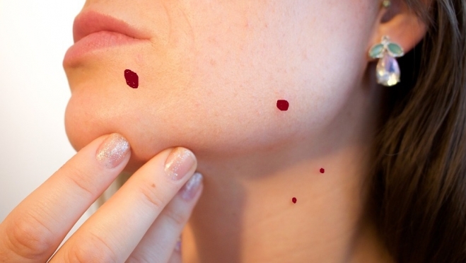 В Марий Эл методом дерматоскопии у 74 человек диагностирована меланома