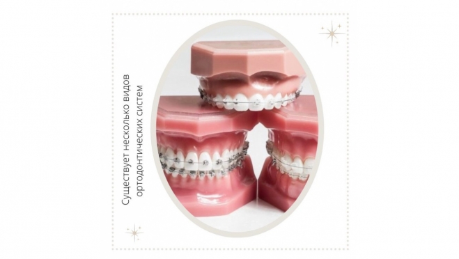 Виды ортодонтических систем
