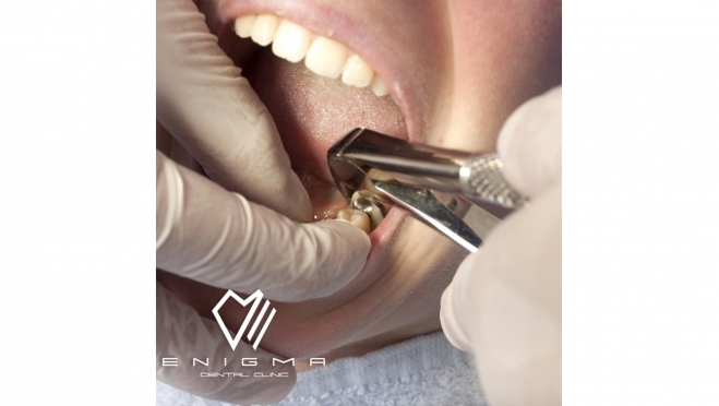 Процедура удаления зубов — это медицинская процедура, при которой стоматолог — хирург удаляет зуб из полости рта.