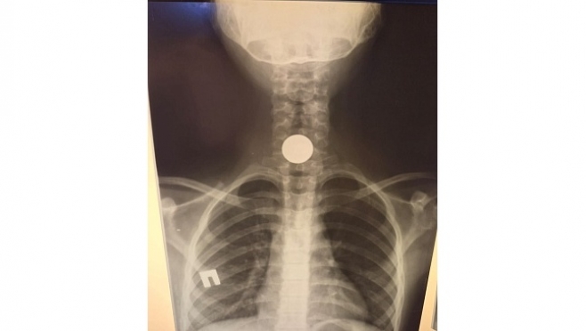 Хирурги извлекли из пищевода ребёнка 5-рублёвую монетку