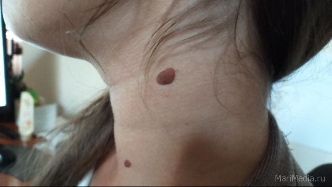 В Йошкар-Оле можно бесплатно провериться на наличие меланомы кожи
