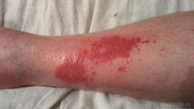 Обморожение — правила профилактики