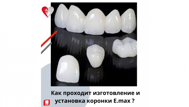 Изготовление и установка коронки E-max