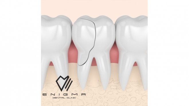 Появление трещин на эмали зуба может быть вызвано различными причинами, несмотря на ее общую прочность
