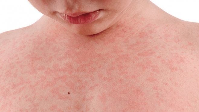 В Самаре зарегистрирована вспышка кори