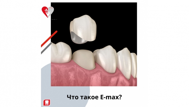 Что такое E-max?