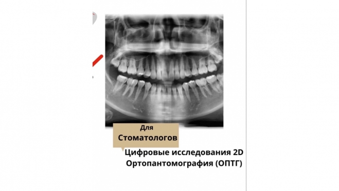 Цифровые исследования 2D. Ортопантомография (ОПТГ)