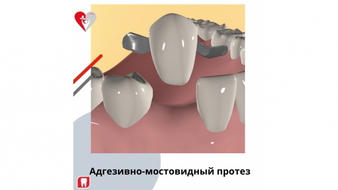 Адгезивно-мостовидный протез