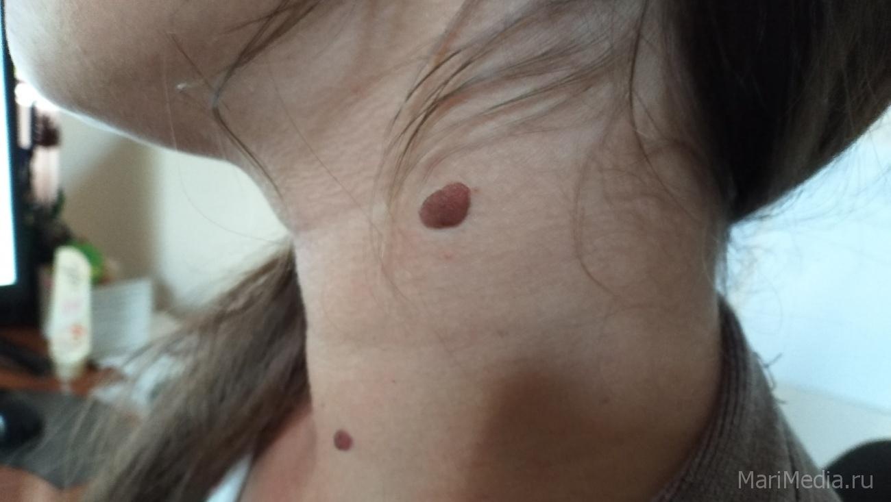 В Йошкар-Оле состоится акция «Дерматоскопия под открытым небом»