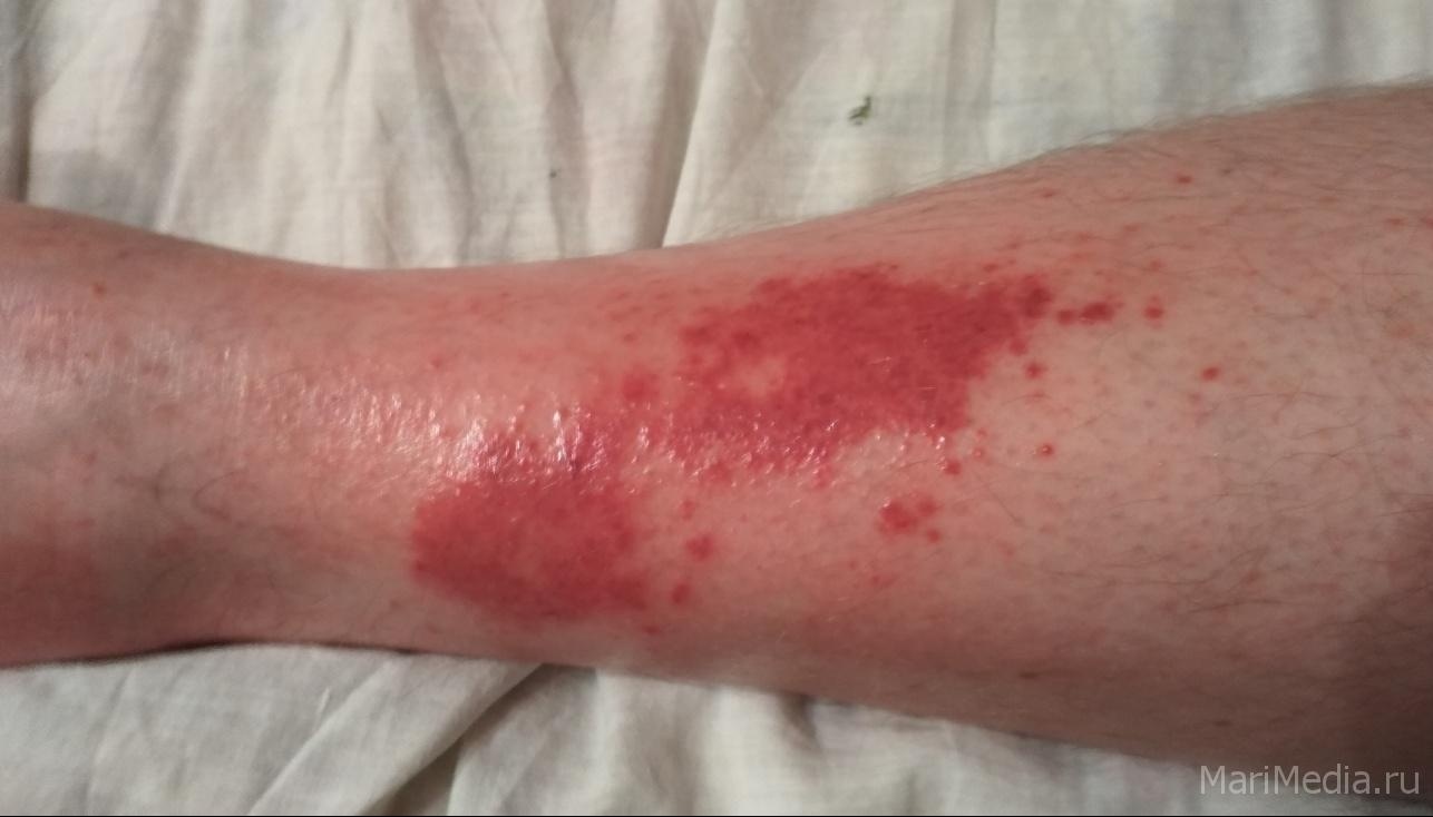 В Йошкар-Олинской горбольнице находятся пациенты с серьёзными обморожениями