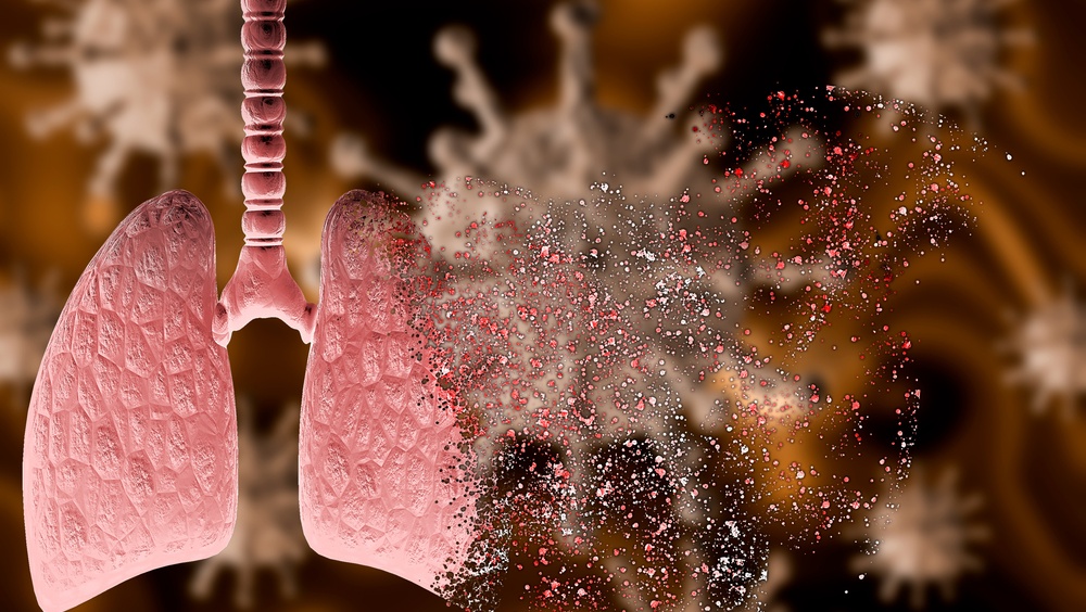 В Марий Эл в выходные от коронавируса скончалось 3 человека