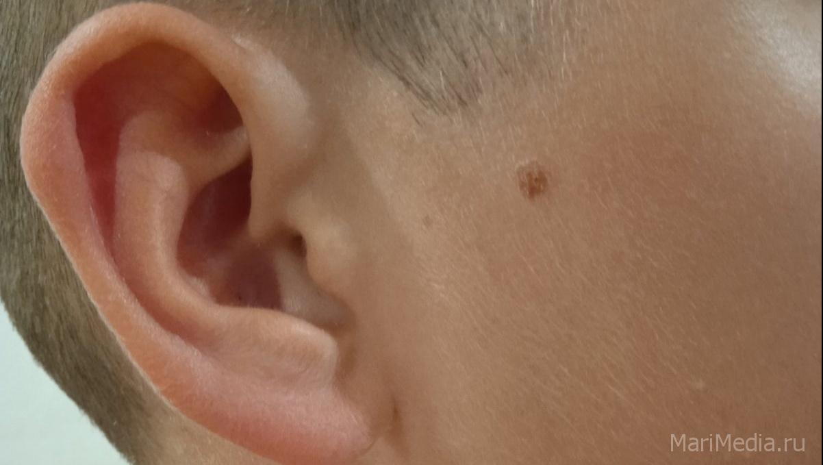 Завтра йошкаролинцы смогут бесплатно провериться на рак кожи